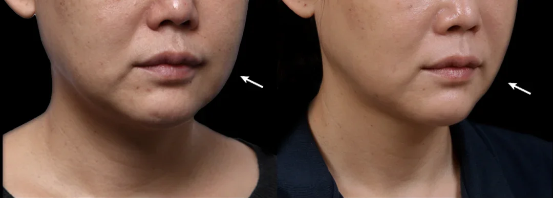 凝境美學美國音波拉提真實案例 美版超聲刀