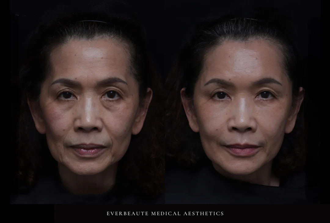 凝境美學診所＿緹奧希玻尿酸示範教學案例＿64歲