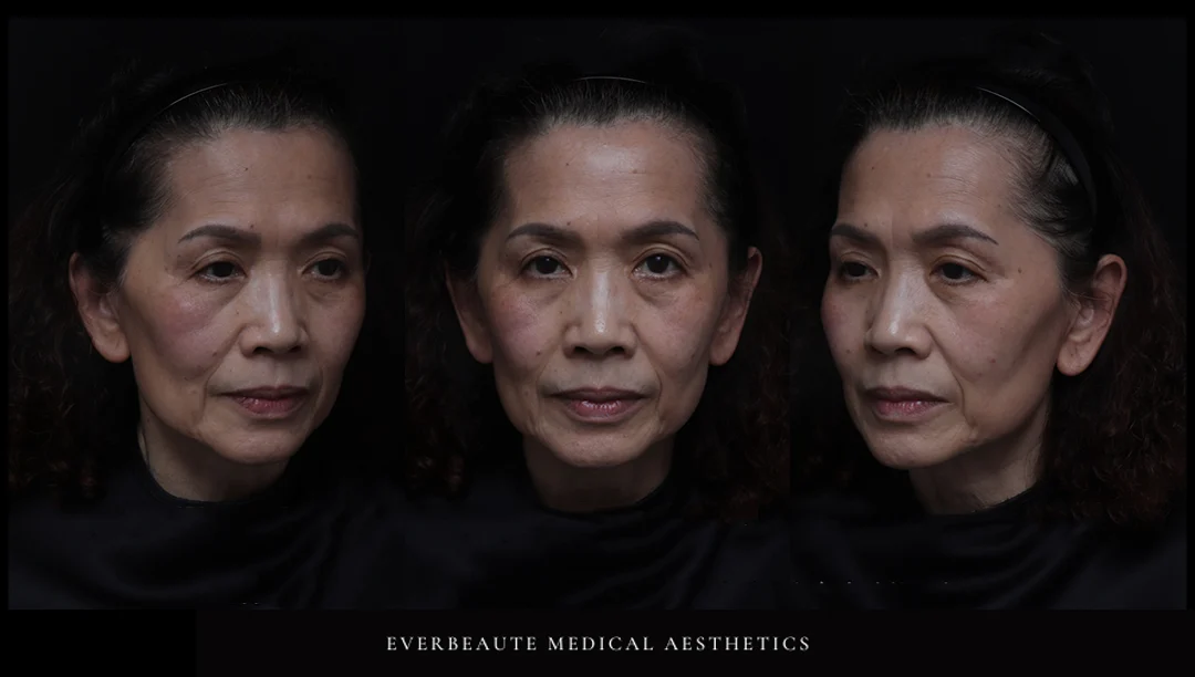 凝境美學診所＿緹奧希玻尿酸示範教學案例＿64歲02