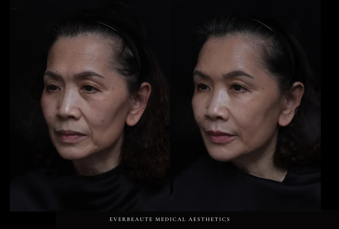 凝境美學診所＿緹奧希玻尿酸示範教學案例＿64歲03