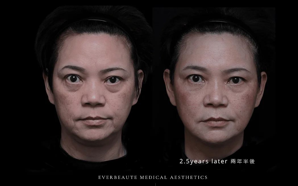 嚴重淚溝 眼袋 嘴邊肉 木偶紋 大安醫美 凝境美學 于曉恩醫師 曾繁聞 大安區整形診所