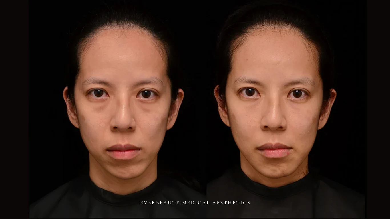 凝境美學診所院長醫師擔任精靈針Aesthefill艾麗斯原廠國際級講師 示範注射教學案例 蘋果肌、臉頰凹陷、淚溝、下巴