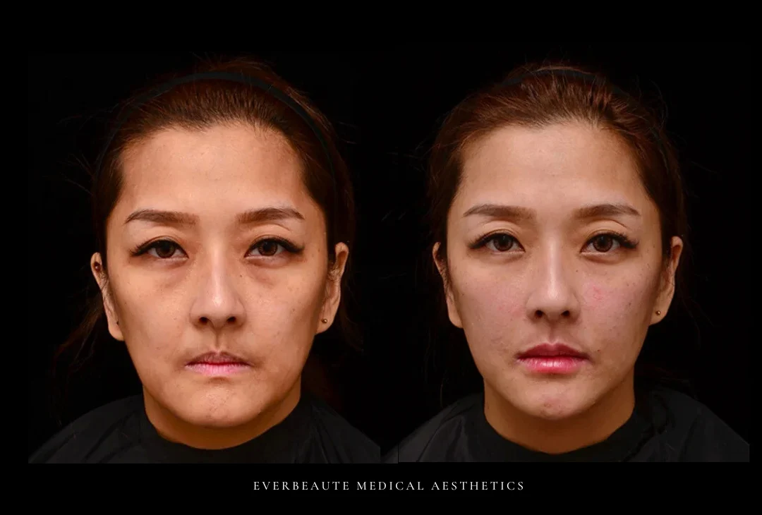 眼窩凹陷 澎潤下巴後縮-｜-41歲女-暴牙-太陽穴額頭凹陷-上眼窩凹下半臉氣質殺手 澎潤 下巴後縮