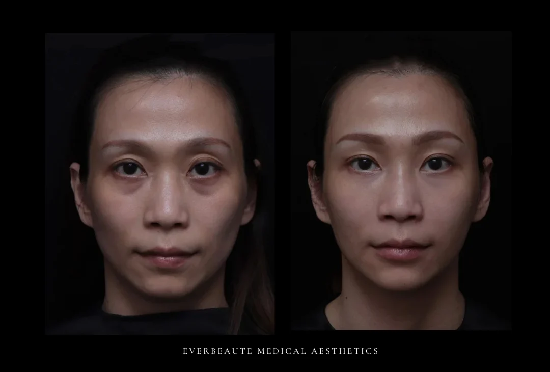 下半臉氣質殺手 – 下巴後縮 ｜ 41歲女 暴牙 太陽穴額頭凹陷 上眼窩凹 下巴短