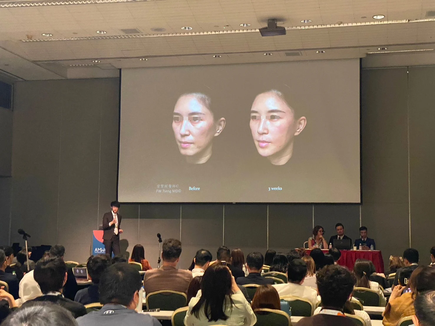 AMWC Asia美容醫學世界大會亞洲年會 曾繁聞醫師演講 嘴邊肉下垂、木偶紋、法令紋、口角皺紋、輪廓線鬆弛等下半臉老化的微整型治療方式，在表情動作頻繁的口周部位，如何搭配合