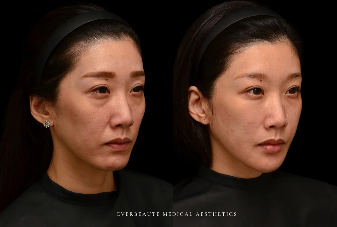 Hyaluronic-acid-filler-injection-by-Dr-Tseng-Fangwen-at-Everbeaute-clinic-Taipei-Taiwan-tear-trough-nasolabial-fold-marionette-line-lip-cheek-chin-jowl-lifting-2509