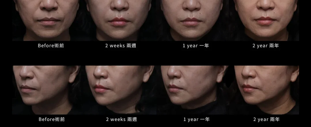 女神動態玻尿酸原廠指定曾繁聞醫師於亞太區微整型大師課程演講教學 台北醫美 大安站醫美 大安醫美 大安區