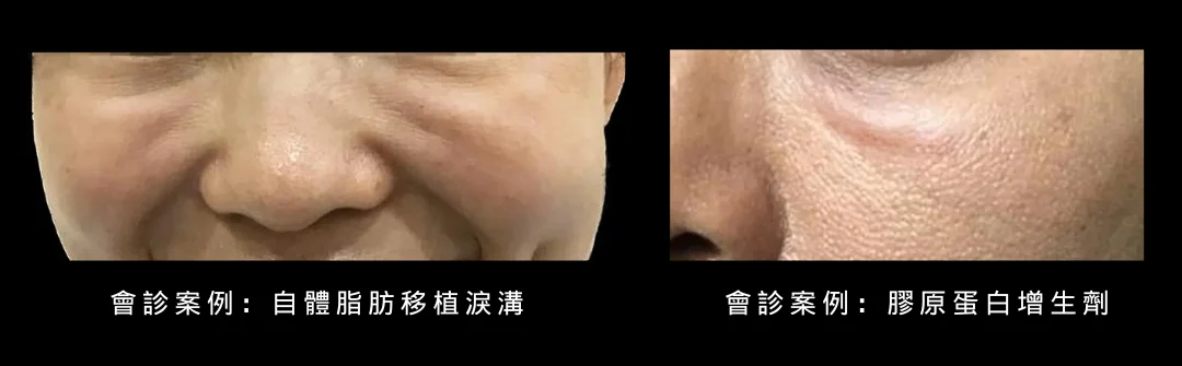 淚溝脂肪填補及膠原增生,但造成突起的毛毛蟲,難以修復 大安站 大安醫美