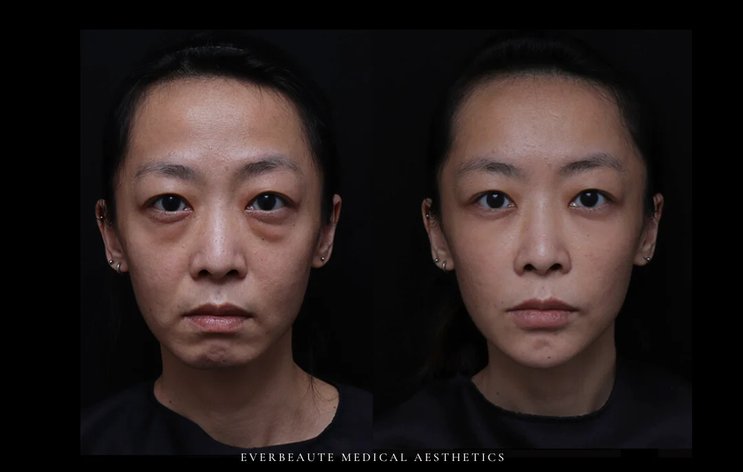 眼袋 曾繁聞醫師 無痕拉提 凝境美學 曾繁聞 22