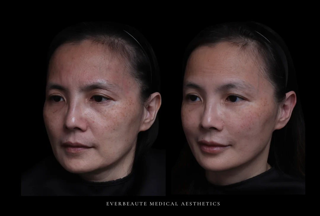 下半臉氣質殺手-–-下巴後縮- 中年婦女 暴牙-太陽穴額頭凹陷-上眼窩凹 熟女