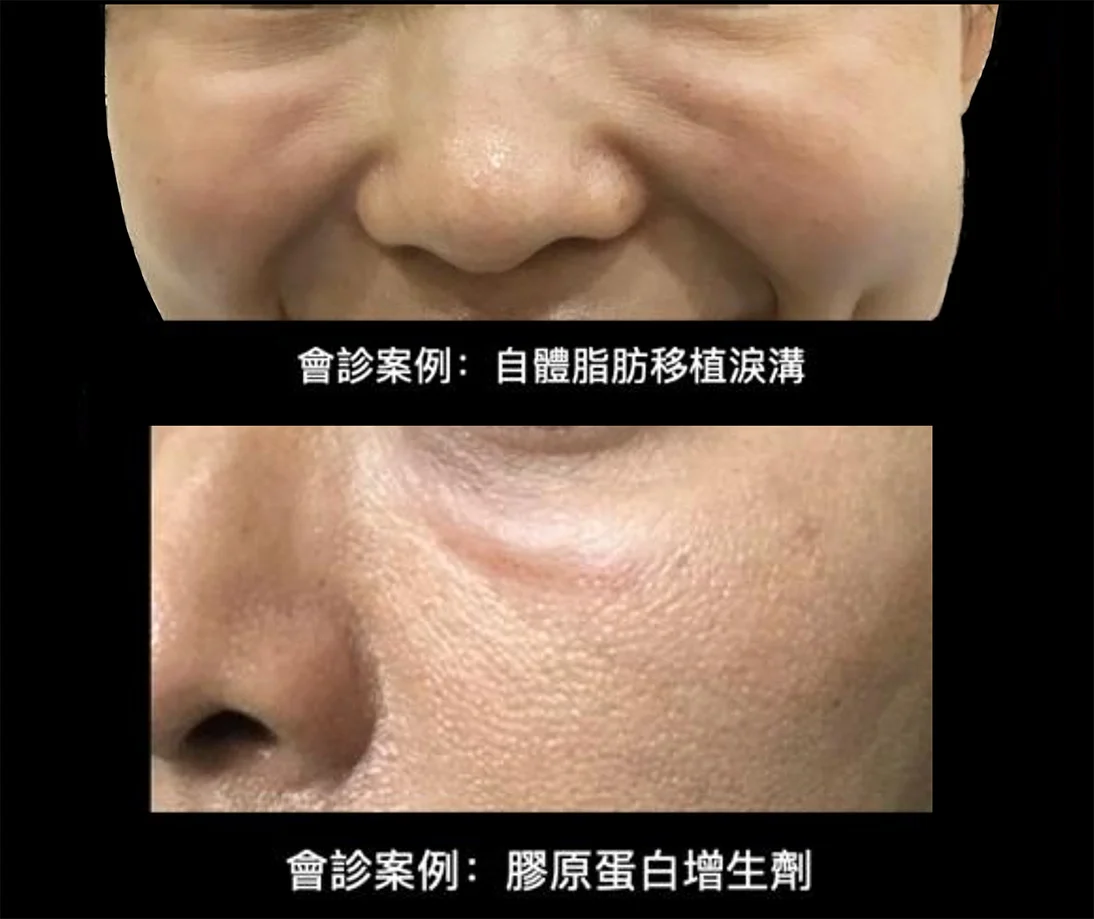淚溝脂肪填補及膠原增生，但造成突起的毛毛蟲，難以修復
