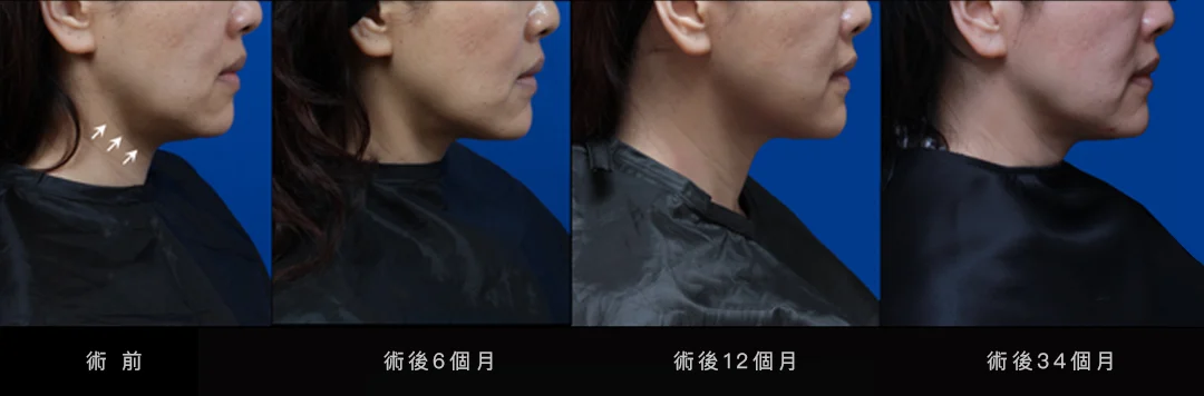 凝境美學音波36個月追蹤_美國音波