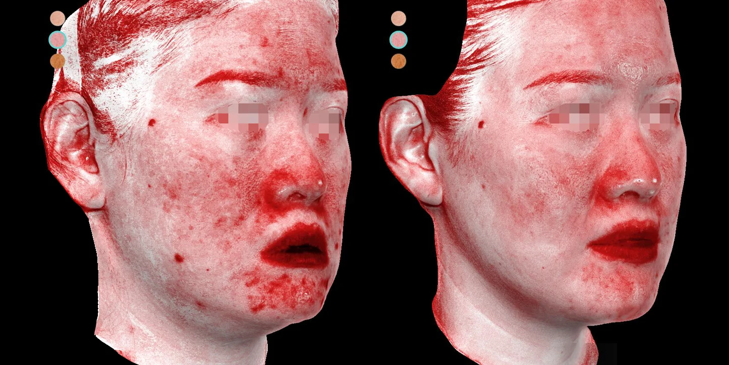 凝境矽谷案例＿痘痘痘疤 毛孔 泛紅3D_3