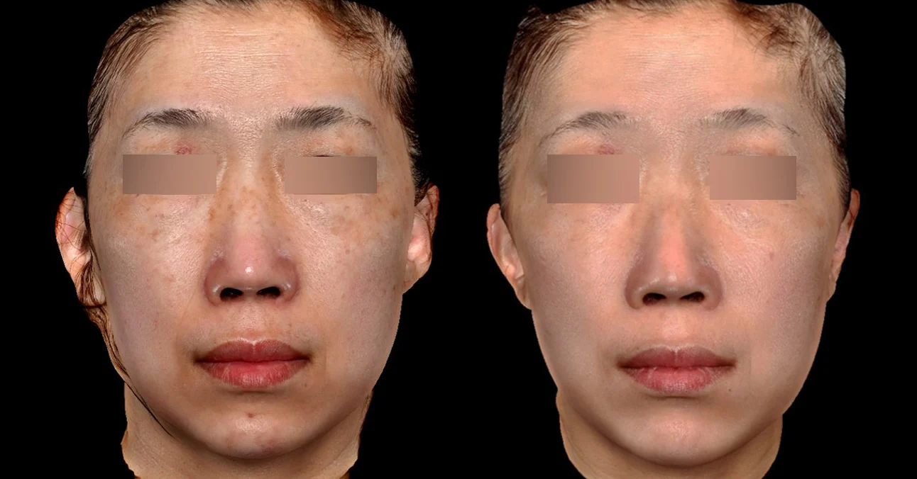 凝境矽谷案例＿肝斑 斑點 法令紋 細紋 抬頭紋 皺紋 鬆弛
