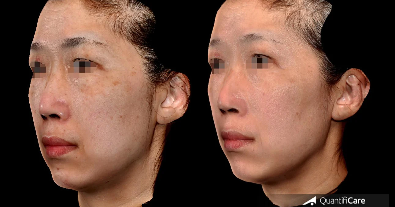 凝境矽谷案例＿肝斑 斑點 法令紋 細紋 抬頭紋 皺紋 鬆弛2