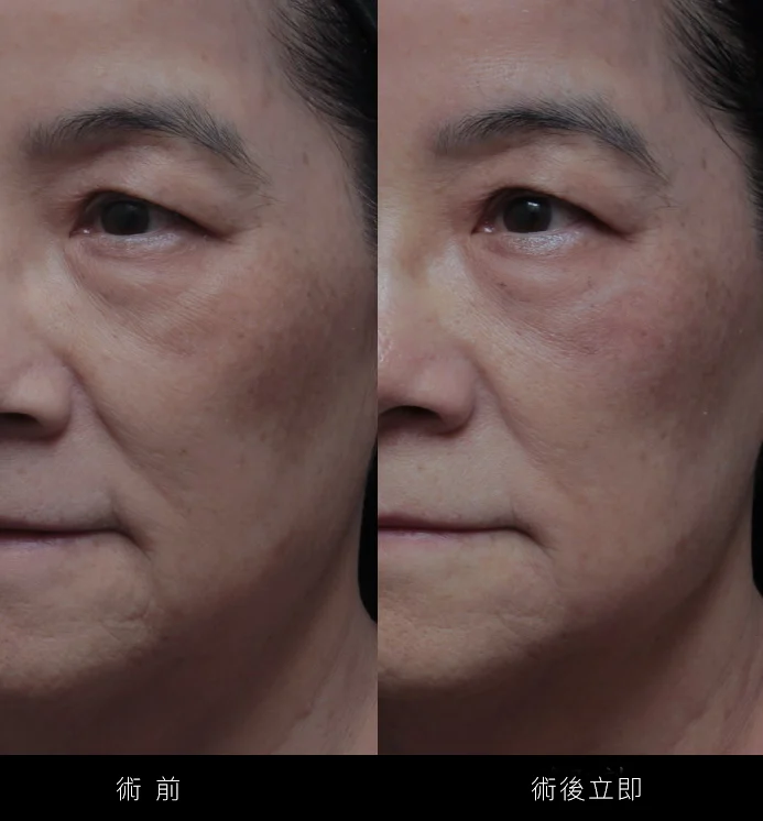 凝境美學鳳凰電波術後立即