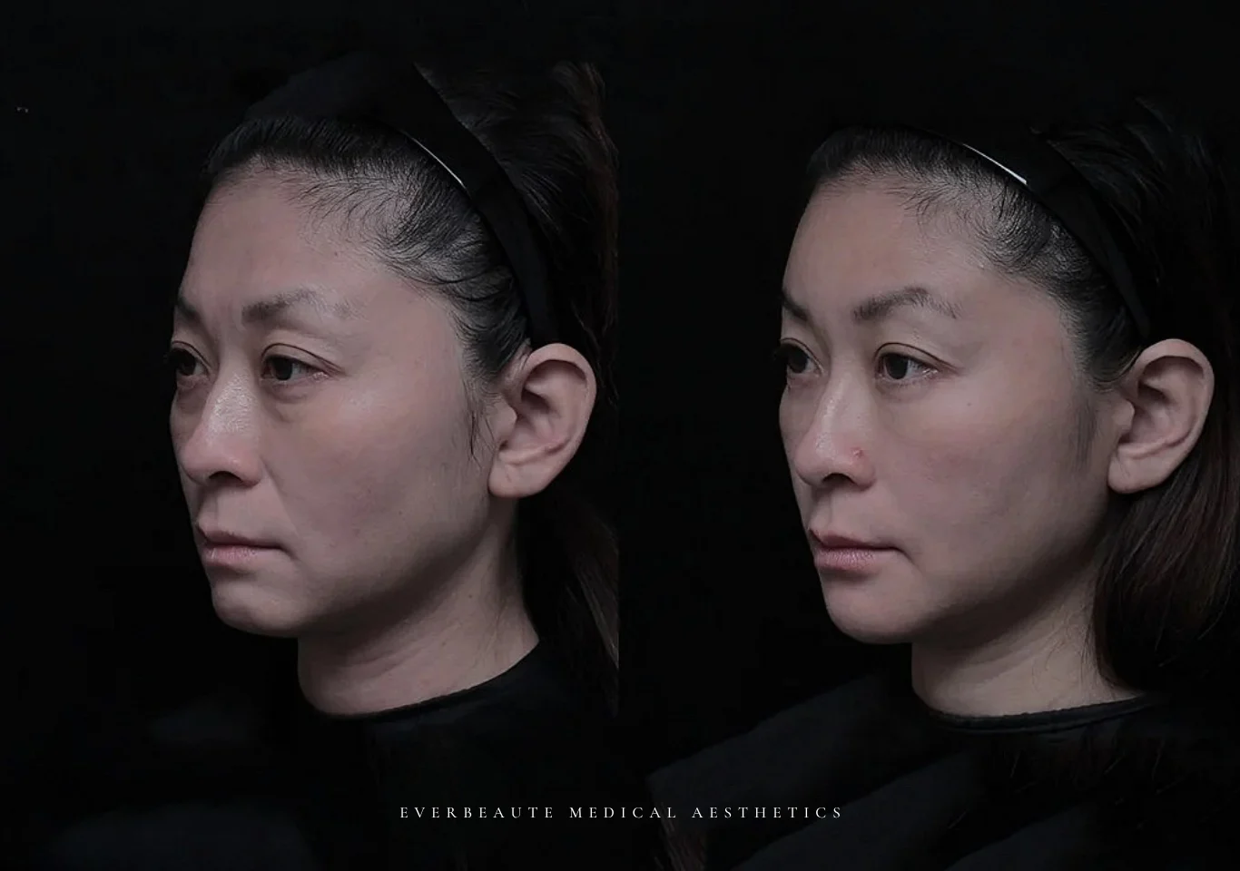 41歲 櫃姐好累 ｜ 淚溝 眼袋 法令紋 額頭扁平 下巴後縮案例