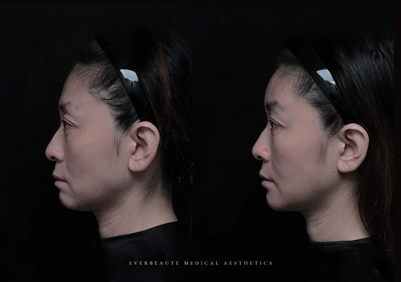 41歲 櫃姐好累 ｜ 淚溝 眼袋 法令紋 額頭扁平 下巴後縮案例1