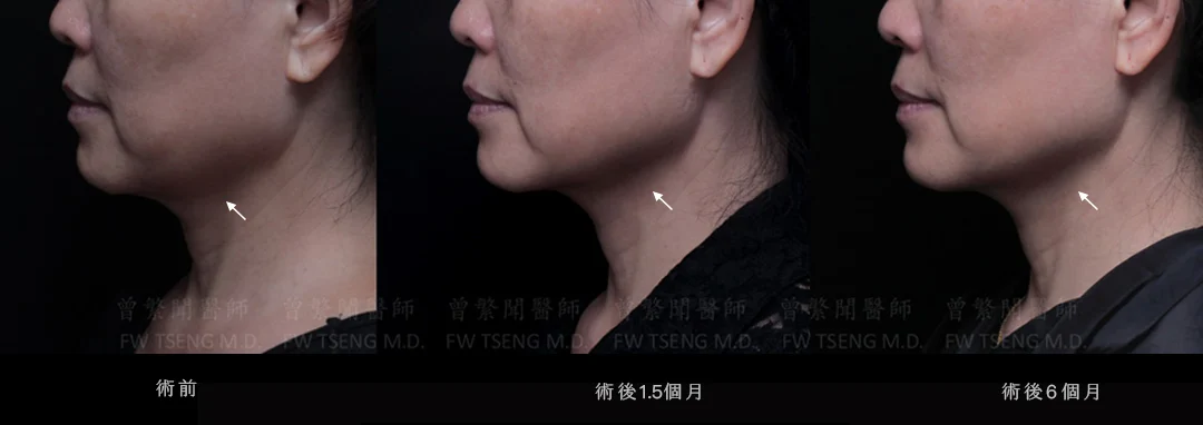 鳳凰電波原廠邀請 曾繁聞醫師教學示範案例：下半臉輪廓鬆弛，下顎線條緊緻