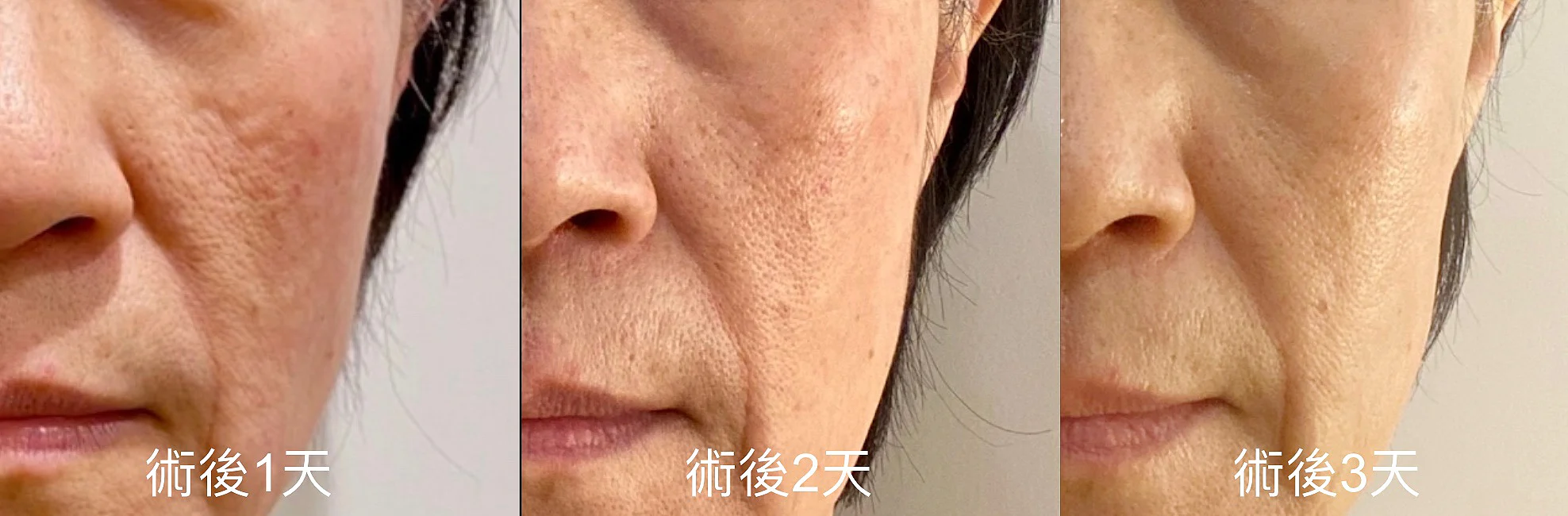 水光針是什麼?凝境美學診所 水光槍 了解水光針dcard上常見問題