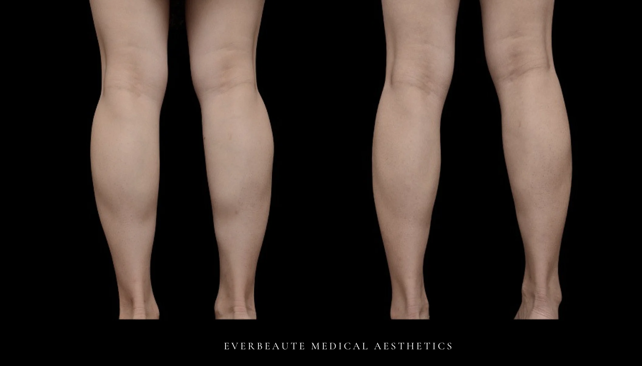 小腿肌肉毒 肉毒瘦小腿 肉毒桿菌瘦小腿 改善小腿粗壯 凝境美學 肌肉型小腿