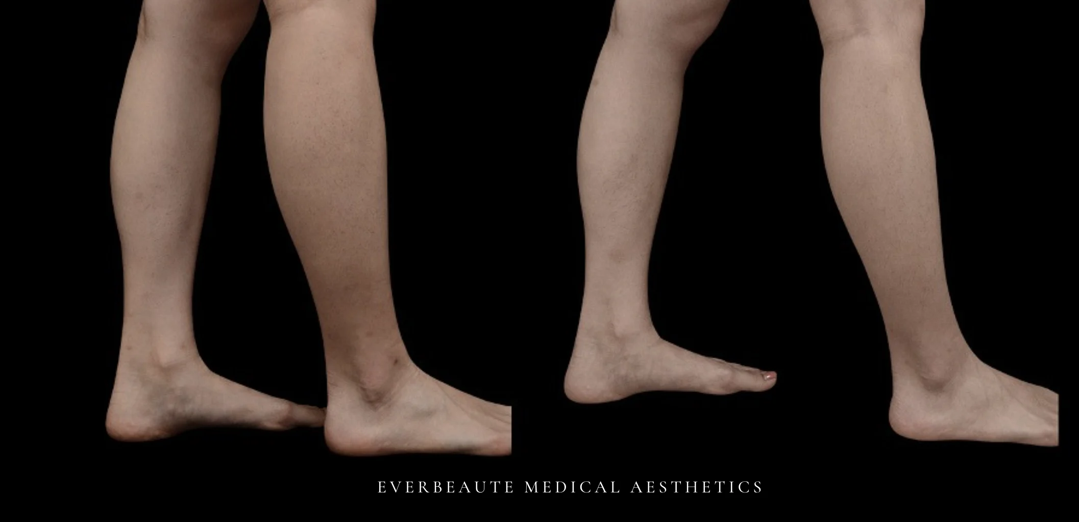 肉毒桿菌瘦小腿術前術後差異比對 小腿肌肉毒 肉毒瘦小腿 肉毒桿菌瘦小腿 改善小腿粗壯 凝境美學 肌肉型小腿