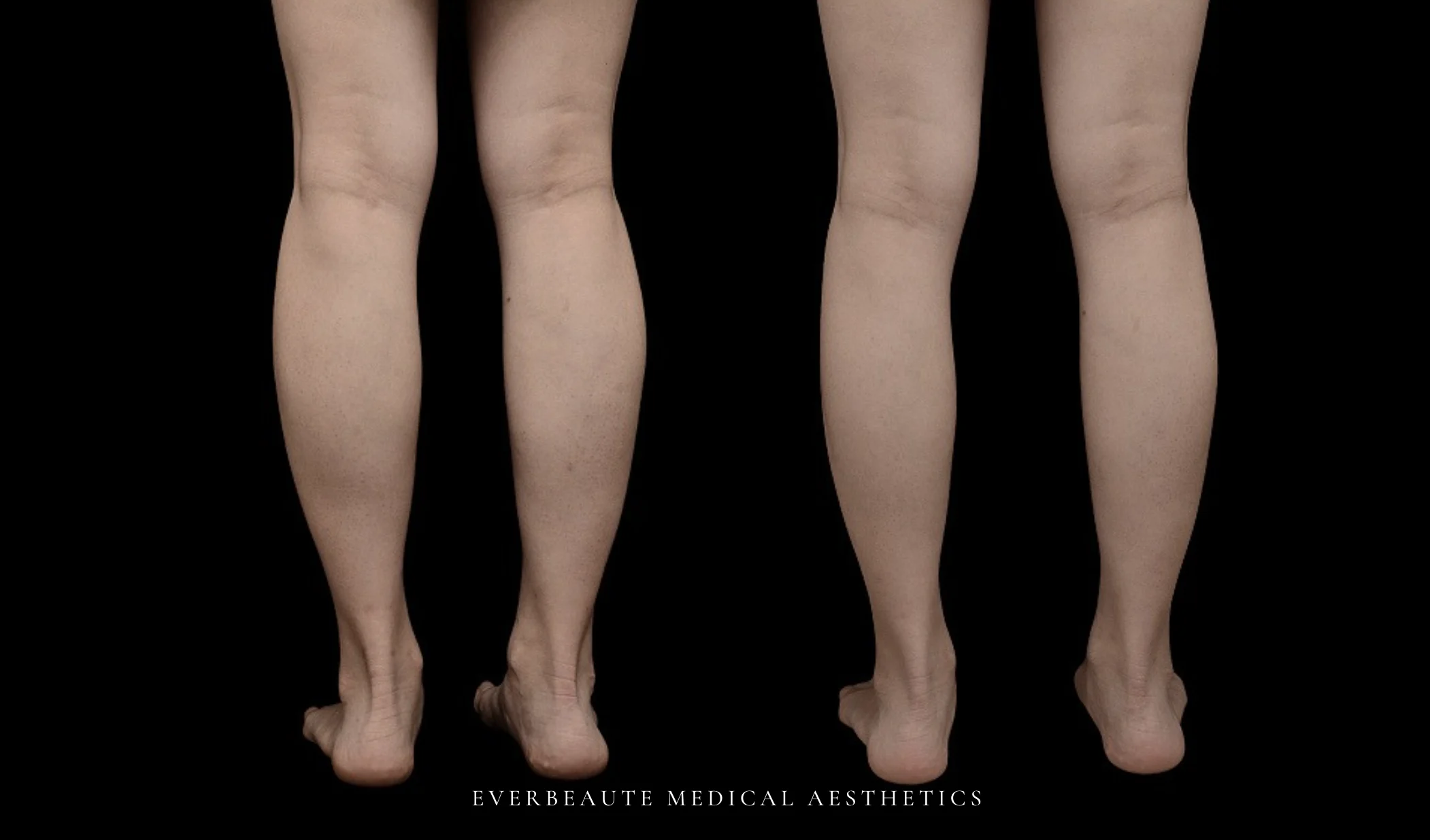 肉毒桿菌瘦小腿術前術後差異比對 小腿肌肉毒 肉毒瘦小腿 肉毒桿菌瘦小腿 改善小腿粗壯 凝境美學 肌肉型小腿 消除蘿蔔腿