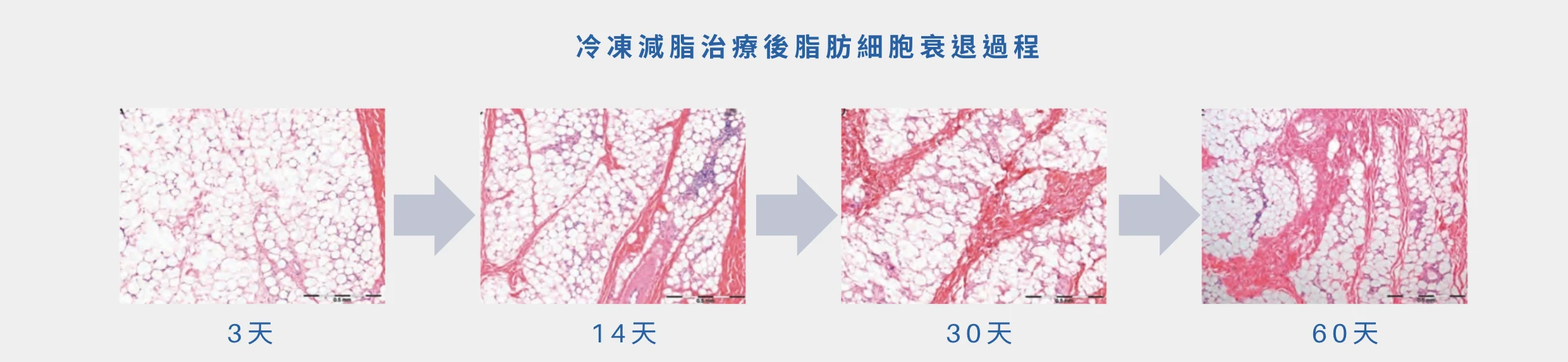 冷凍減脂治療後脂肪細胞衰退過程 酷塑冷凍減脂 coolsculpting elite