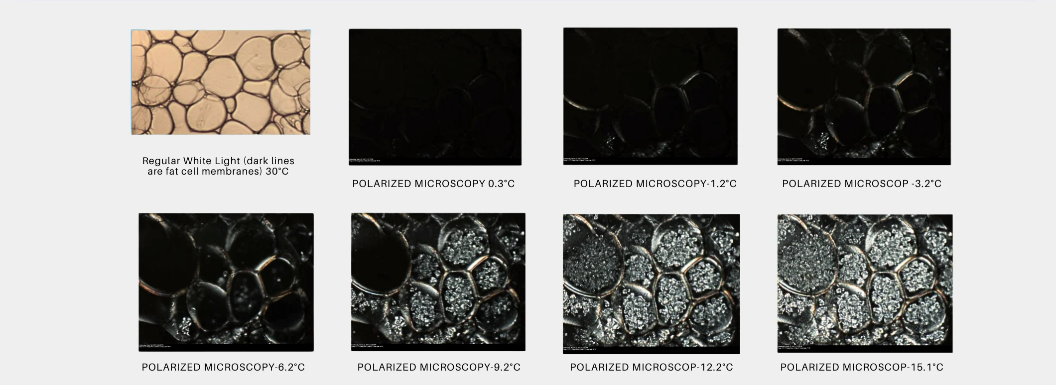 脂肪細胞在不同溫度下的結晶過程
隨著溫度降低，脂肪細胞內的脂質開始結晶，這一過程有助於觸發脂肪細胞的凋亡，最終促進脂肪的減少。圖片展示了從常溫到-15.1°C不同溫度下脂肪細胞的變化。