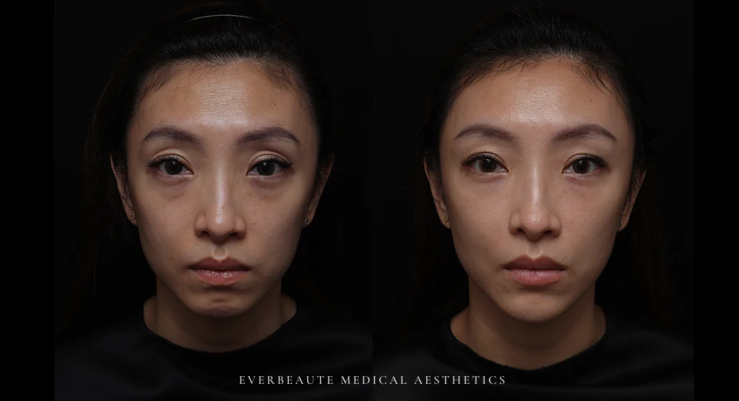 淚溝 黑眼圈 上眼窩凹陷 下巴後縮 嘴邊肉凸出 太陽穴凹陷 凝境美學 大安醫美 于曉恩曾繁聞 精靈針 Aesthefill艾麗斯 蘋果肌、雙頰凹陷、法令紋、⽊偶紋