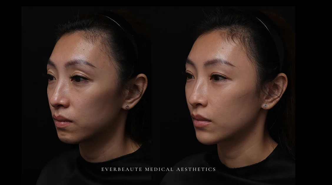 淚溝 黑眼圈 上眼窩凹陷 下巴後縮 嘴邊肉凸出 太陽穴凹陷 凝境美學 大安醫美 于曉恩曾繁聞 精靈針 Aesthefill艾麗斯 蘋果肌、雙頰凹陷、法令紋、⽊偶紋 太陽⽳（夫妻宮）凹陷