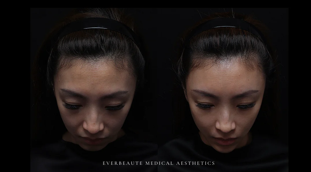 淚溝 黑眼圈 上眼窩凹陷 下巴後縮 嘴邊肉凸出 太陽穴凹陷 凝境美學 大安醫美 于曉恩曾繁聞 精靈針 Aesthefill艾麗斯 蘋果肌、雙頰凹陷、法令紋、⽊偶紋 嘴角紋