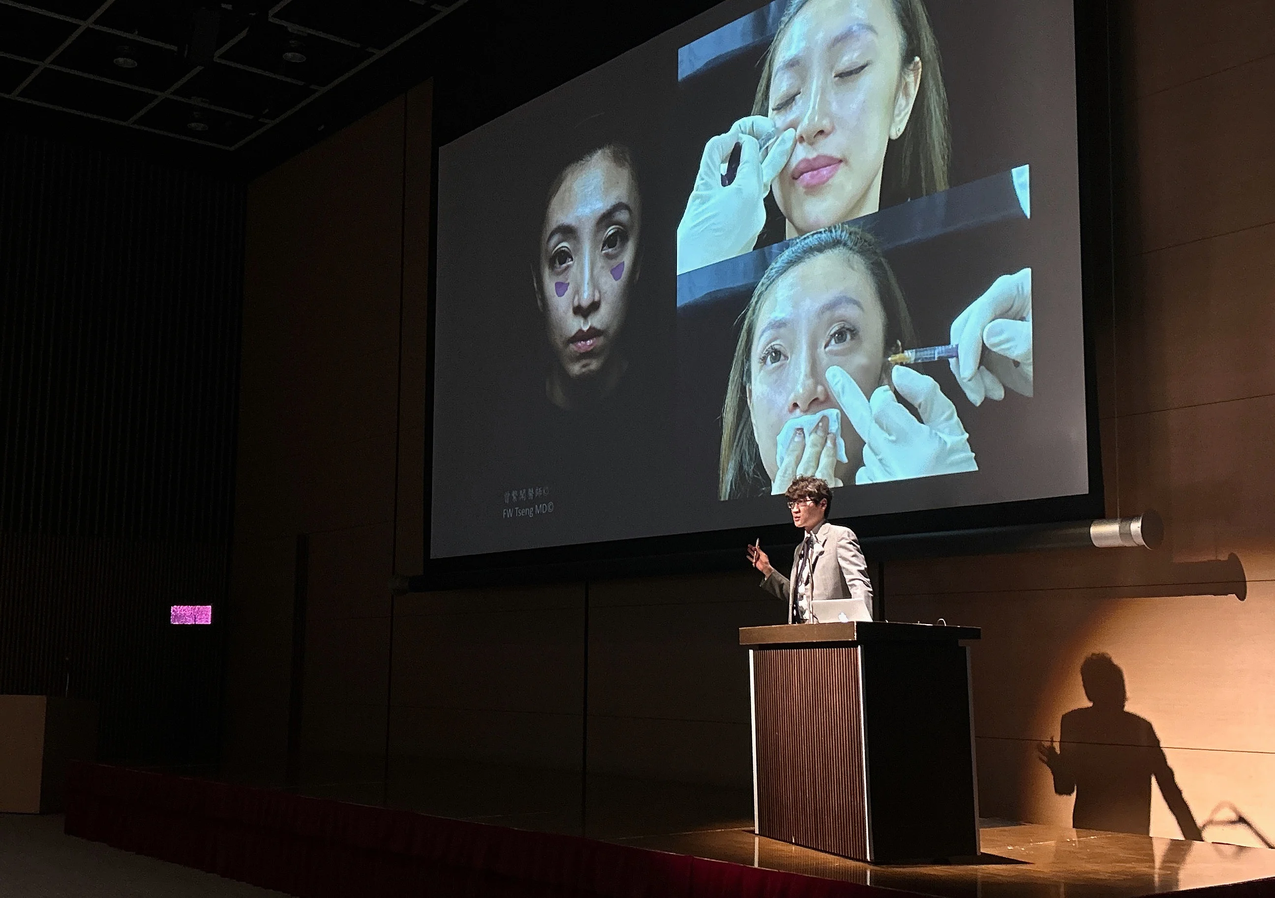 本案例為精靈針Aesthefill艾麗斯原廠邀請曾繁聞院長演講教學示範案例。已取得肖像權同意。
本案例分享衛教資訊無法取代醫師實際診療，仍需與醫師討論治療目的、過程、可能的副作用、照顧方式。