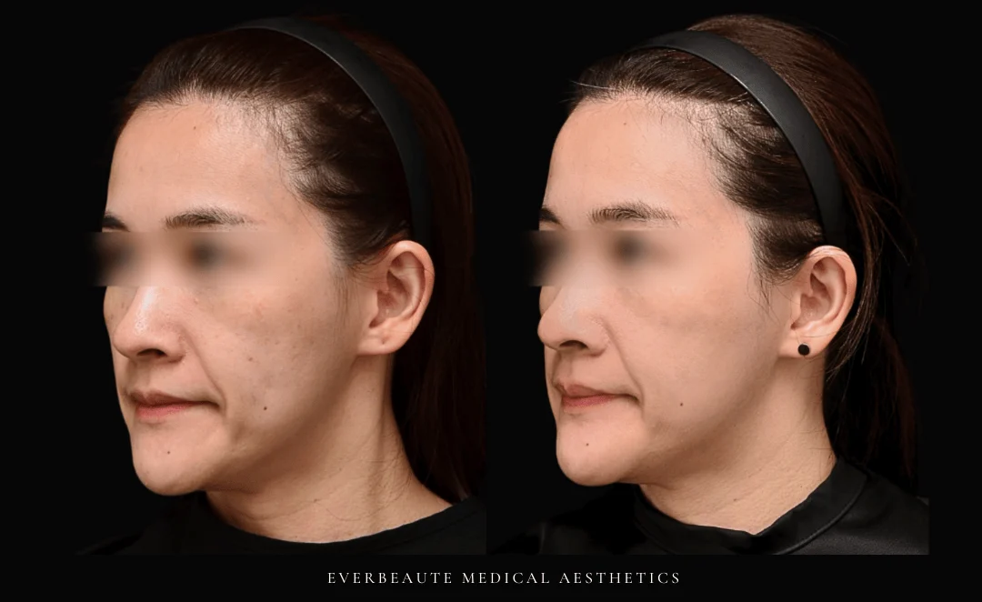 Syndeo 淡化斑點 海菲秀二代Hydrafacial Syndeo 大安醫美 凝境美學 于曉恩醫師 去角質 清粉刺 深層清潔 海菲秀價格 海菲秀二代差異 清潔毛孔 膚質管理 皮膚管理 潔比爾