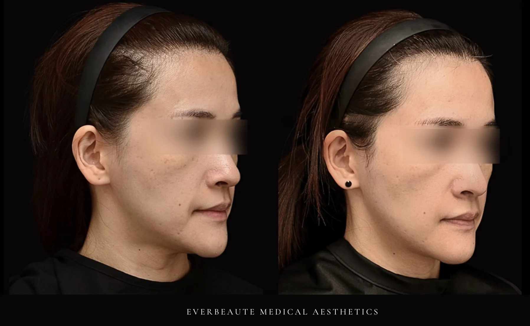 Syndeo 淡化斑點 海菲秀二代Hydrafacial Syndeo 大安醫美 凝境美學 于曉恩醫師 去角質 清粉刺 深層清潔 海菲秀價格 海菲秀二代差異 毛孔