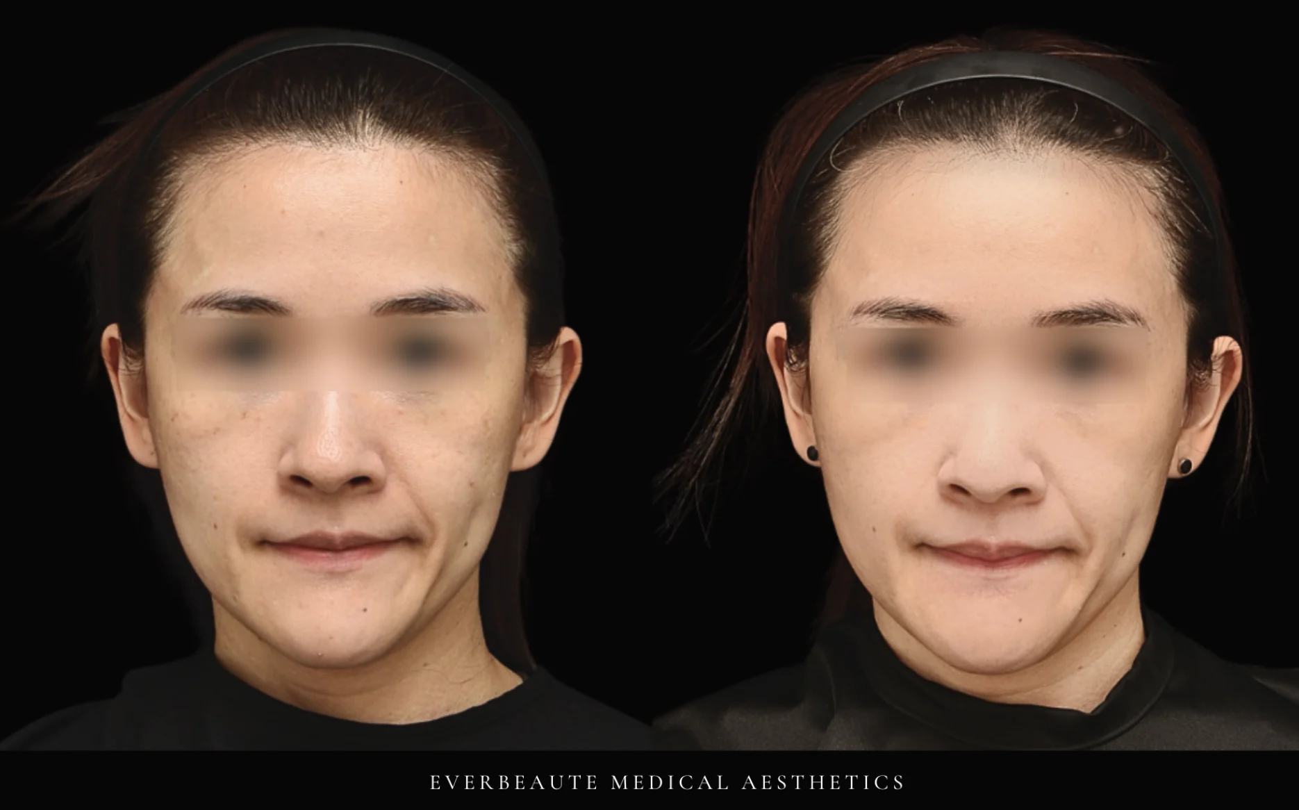 Syndeo 淡化斑點 海菲秀二代Hydrafacial Syndeo 大安醫美 凝境美學 于曉恩醫師 去角質 清粉刺 深層清潔 海菲秀價格 海菲秀二代差異