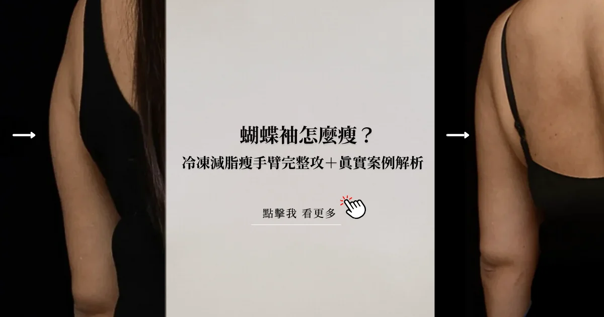 手臂粗 蝴蝶袖 掰掰袖 冷凍減脂 瘦手臂 凝境美學 于曉恩 減肥 手臂雕塑