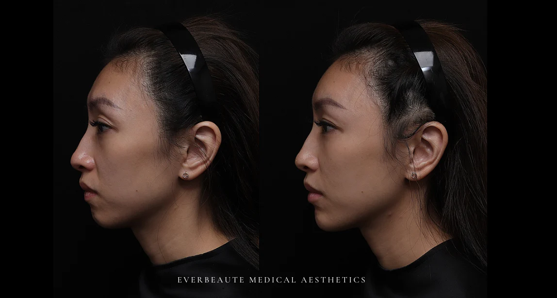 淚溝 黑眼圈 上眼窩凹陷 下巴後縮 嘴邊肉凸出 太陽穴凹陷 凝境美學 大安醫美 于曉恩曾繁聞 精靈針 Aesthefill艾麗斯 蘋果肌、雙頰凹陷、法令紋、⽊偶紋 太陽⽳（夫妻宮）凹陷 膠原蛋白