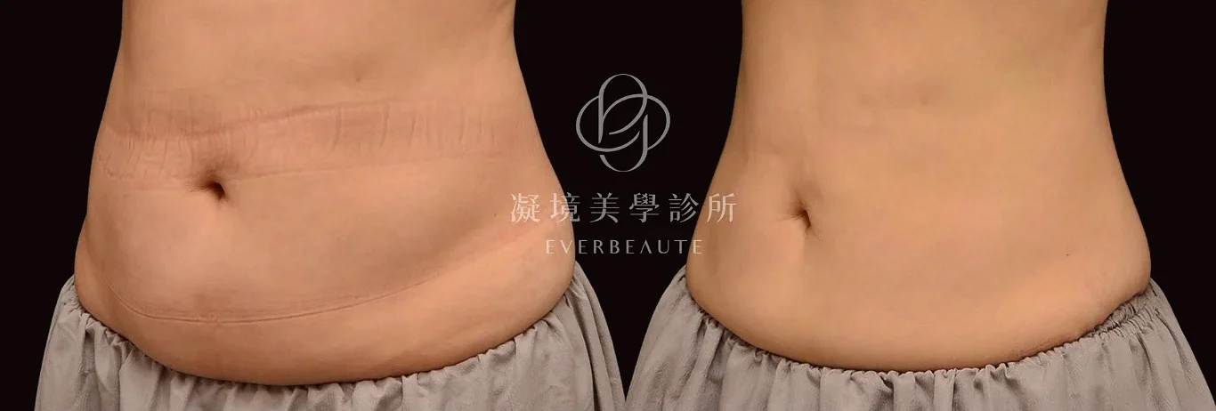 凝境美學 酷塑elite-美國冷凍減脂 腹部瘦身 于曉恩醫師