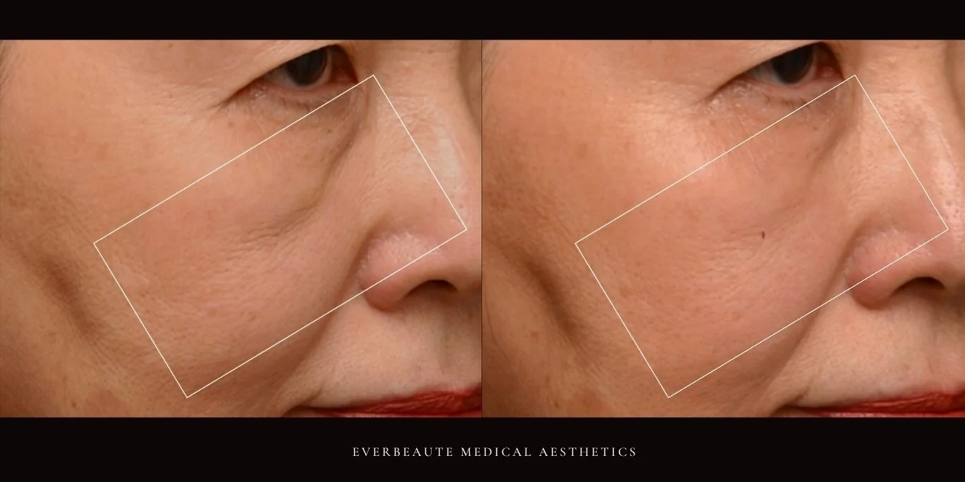 索夫波 鳳凰電波 Thermage FLX 無雙電波 oligio X 超完美電波 熱馬極 塑美極 美國音波 極線音波拉提 Z音波 第三代海芙音波 第四代 媚必提 MPT 超聲刀 鈦提升 台北醫美推薦 大安區醫美 除皺 皺紋 抬頭紋 魚尾紋 眼下細紋 眼周老化 緊緻 膠原蛋白增生 彈力蛋白增生 非手術 不動刀 無痕拉提 凝境美學診所 曾繁聞醫師 于曉恩醫師 皮膚科 專科 專業 好評 院長 原廠講師級 效果自然 微整形 價格 痛 舒眠 麻醉 副作用 後遺症 體驗分享 dcard ptt 成功案例 2