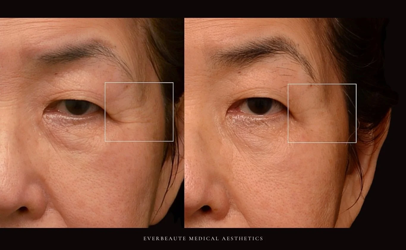 索夫波 鳳凰電波 Thermage FLX 無雙電波 oligio X 超完美電波 熱馬極 塑美極 美國音波 極線音波拉提 Z音波 第三代海芙音波 第四代 媚必提 MPT 超聲刀 鈦提升 台北醫美推薦 大安區醫美 除皺 皺紋 抬頭紋 魚尾紋 眼下細紋 眼周老化 緊緻 膠原蛋白增生 彈力蛋白增生 非手術 不動刀 無痕拉提 凝境美學診所 曾繁聞醫師 于曉恩醫師 皮膚科 專科 專業 好評 院長 原廠講師級 效果自然 微整形 價格 痛 舒眠 麻醉 副作用 後遺症 體驗分享 dcard ptt 成功案例