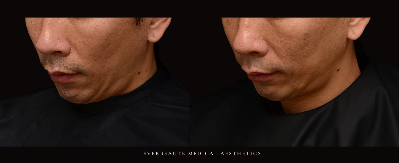 索夫波 鳳凰電波 Thermage FLX 無雙電波 oligio X 超完美電波 熱馬極 塑美極 美國音波 極線音波拉提 Z音波 第三代海芙音波 第四代 媚必提 MPT 超聲刀 鈦提升 Onda pro 台北醫美推薦 大安區醫美 除皺 皺紋 抬頭紋 眼皮無力 眼下細紋 眼周老化 下顎線 雙下巴 溶脂 減脂 緊緻 提升 嘴邊肉下垂 火雞脖子 頸部鬆弛 頸紋霜 膠原蛋白增生 彈力蛋白增生 非手術 不動刀 無痕拉提 凝境美學診所 曾繁聞醫師 于曉恩醫師 皮膚科 專科 專業 好評 院長 原廠講師級 效果自然 微整形 價格 痛 舒眠 麻醉 副作用 後遺症 體驗分享 dcard ptt 成功案例