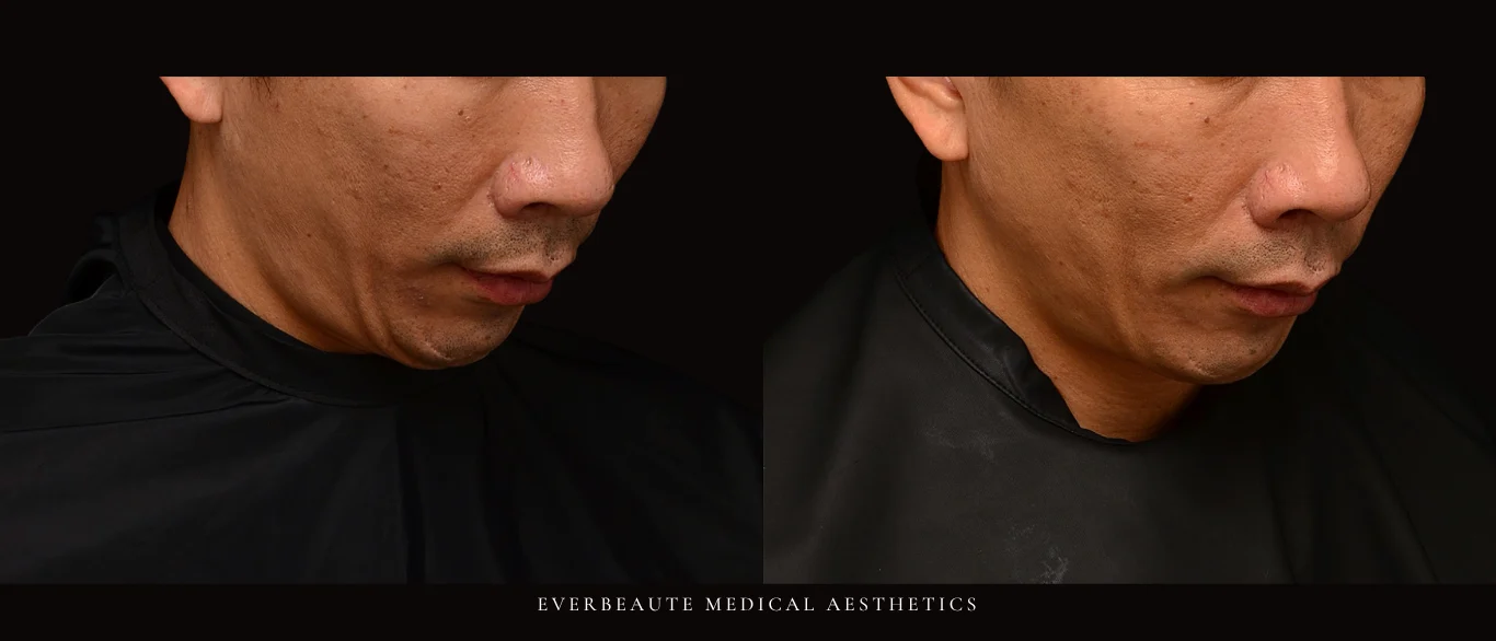 索夫波 鳳凰電波 Thermage FLX 無雙電波 oligio X 超完美電波 熱馬極 塑美極 美國音波 極線音波拉提 Z音波 第三代海芙音波 第四代 媚必提 MPT 超聲刀 鈦提升 Onda pro 台北醫美推薦 大安區醫美 除皺 皺紋 抬頭紋 眼皮無力 眼下細紋 眼周老化 下顎線 雙下巴 溶脂 減脂 緊緻 提升 嘴邊肉下垂 火雞脖子 頸部鬆弛 頸紋霜 膠原蛋白增生 彈力蛋白增生 非手術 不動刀 無痕拉提 凝境美學診所 曾繁聞醫師 于曉恩醫師 皮膚科 專科 專業 好評 院長 原廠講師級 效果自然 微整形 價格 痛 舒眠 麻醉 副作用 後遺症 體驗分享 dcard ptt 成功案例