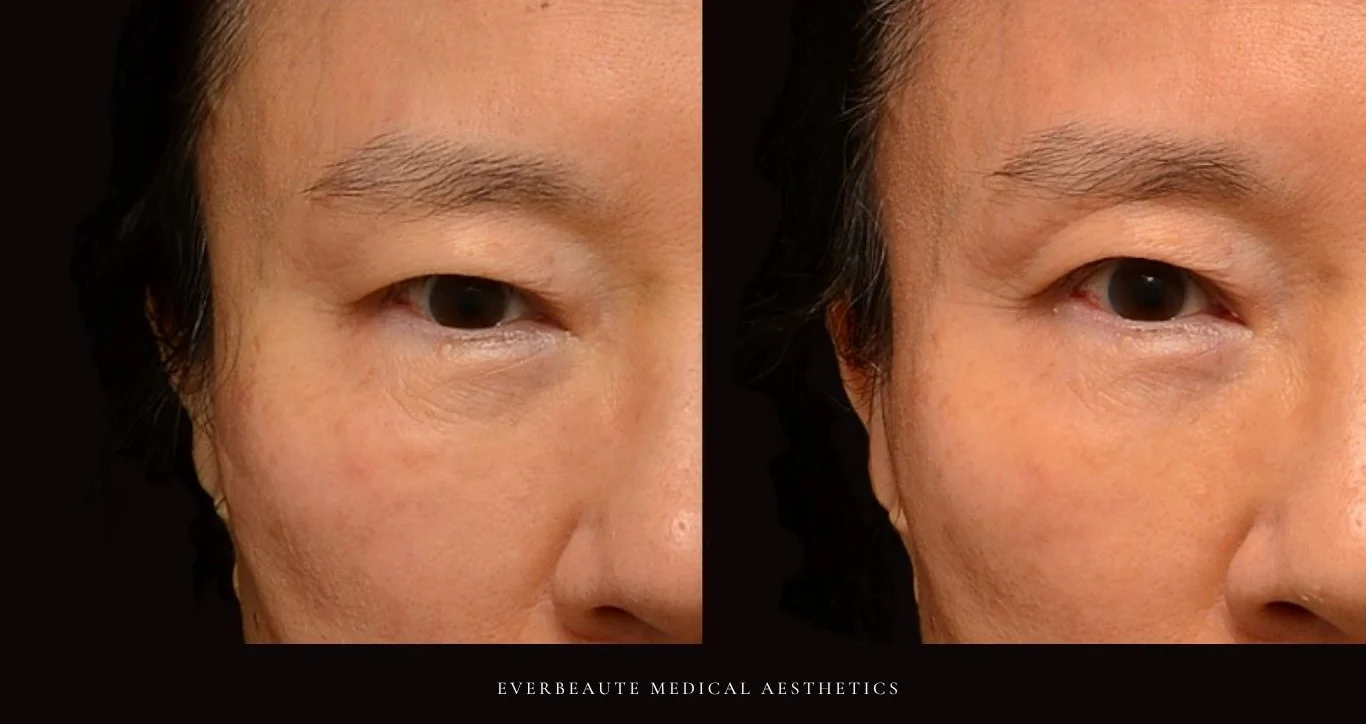 索夫波 鳳凰電波 Thermage FLX 無雙電波 oligio X 超完美電波 熱馬極 塑美極 美國音波 極線音波拉提 Z音波 第三代海芙音波 第四代 媚必提 MPT 超聲刀 鈦提升 台北醫美推薦 大安區醫美  眼皮無力 眼皮下垂 眼周老化 緊緻 提升 膠原蛋白增生 彈力蛋白增生 非手術 不動刀 無痕拉提 凝境美學診所 曾繁聞醫師 于曉恩醫師 皮膚科 專科 專業 好評 院長 原廠講師級 效果自然 微整形 價格 痛 舒眠 麻醉 副作用 後遺症 體驗分享 dcard ptt 成功案例