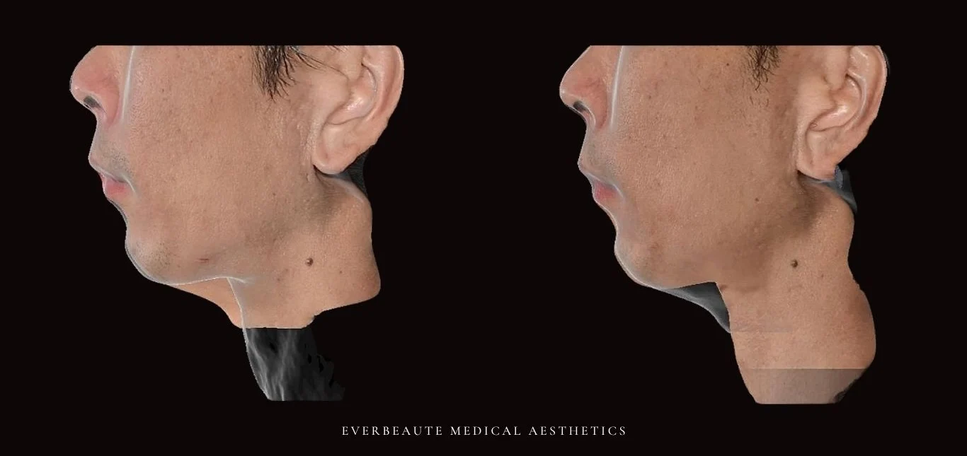 索夫波 鳳凰電波 Thermage FLX 無雙電波 oligio X 超完美電波 熱馬極 塑美極 美國音波 極線音波拉提 Z音波 第三代海芙音波 第四代 媚必提 MPT 超聲刀 鈦提升 Onda pro 台北醫美推薦 大安區醫美 下顎線 雙下巴 溶脂 減脂 緊緻 提升 嘴邊肉下垂 火雞脖子 頸部鬆弛 頸紋霜 膠原蛋白增生 彈力蛋白增生 非手術 不動刀 無痕拉提 凝境美學診所 曾繁聞醫師 于曉恩醫師 皮膚科 專科 專業 好評 院長 原廠講師級 效果自然 微整形 價格 痛 舒眠 麻醉 副作用 後遺症 體驗分享 dcard ptt 成功案例