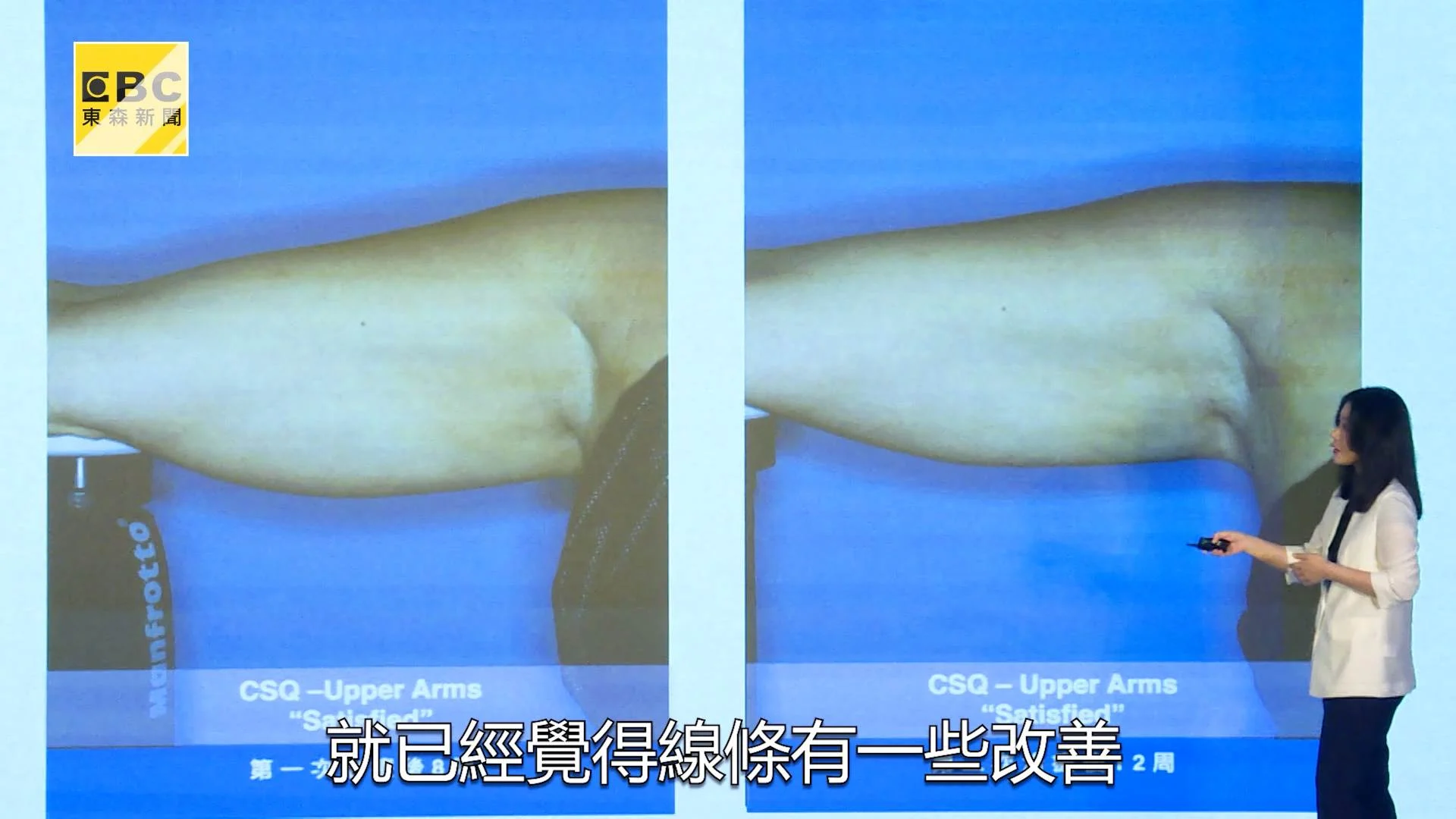 美國冷凍減脂最高可減少約27%脂肪厚度。（圖／東森新聞）