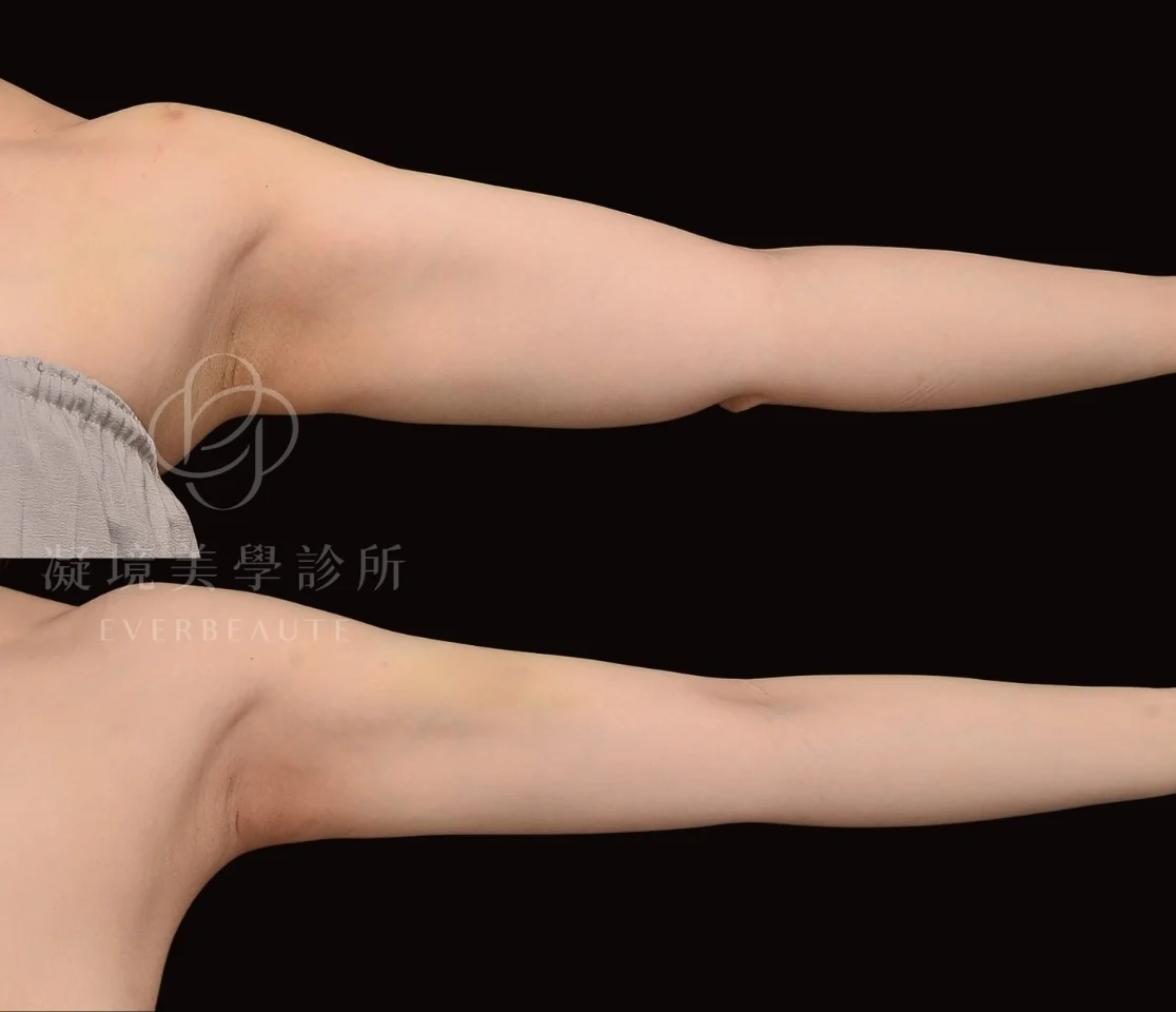 酷塑elite 美國冷凍減脂 瘦手臂 掰掰袖 蝴蝶袖