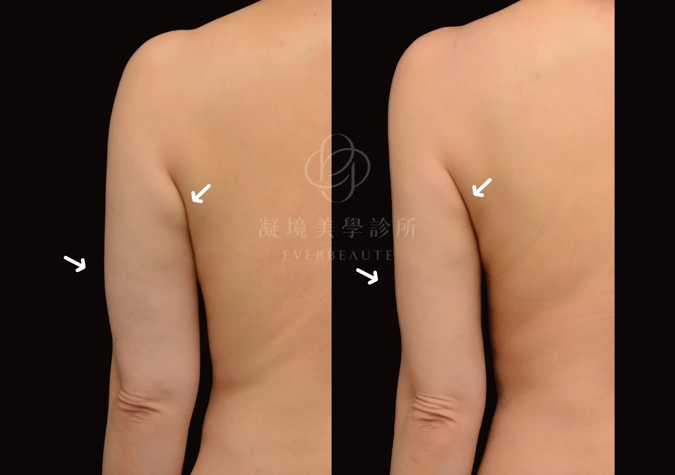 酷塑elite 美國冷凍減脂 瘦手臂 掰掰袖 蝴蝶袖 凝境美學診所 案例 曾繁聞醫師 于曉恩醫師