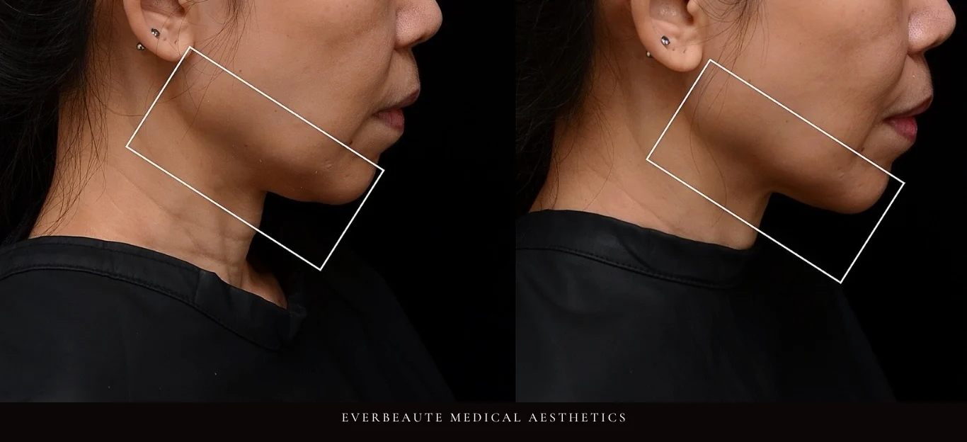 逆時針Profhilo原廠指定凝境美學診所曾繁聞院長示範注射案例，皮膚科醫學會年會演講：改善眼下細紋、臉頰乾紋與口角皺紋，膚質緊緻透亮自然，深層保濕效果顯著。