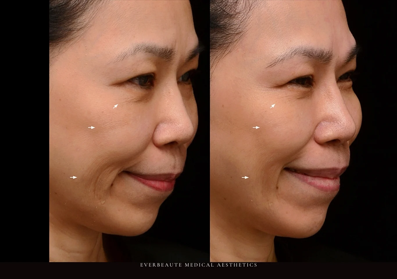 逆時針Profhilo原廠指定凝境美學診所曾繁聞院長示範注射案例，皮膚科醫學會年會演講：改善眼下細紋、臉頰乾紋與口角皺紋，膚質緊緻透亮自然，深層保濕效果顯著。